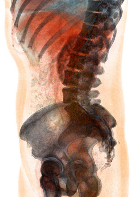 Volume Rendering CT Scans By Voxel123