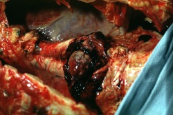 orqueen:Thoracic Aortic Aneurysm: gross, ruptured thoracic aorta aneurysm, in situ lower thoracic portion