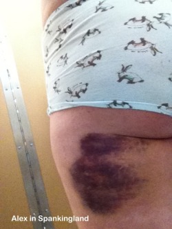 alexinspankingland:  Bruise.  