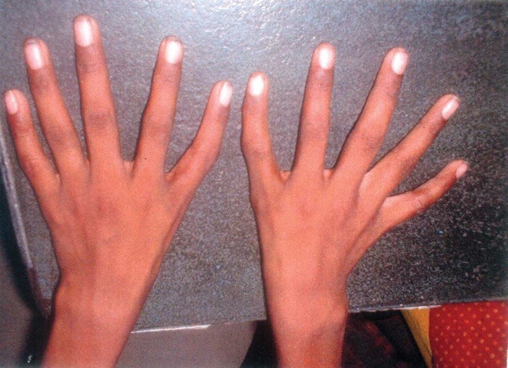 A triphalangeal thumb (TPT) is a congenital malformation where the thumb has three