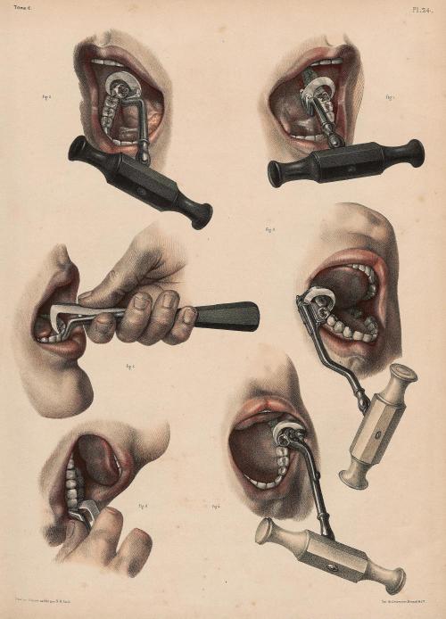 nemfrog:Tooth extractions. Traité complet de l'anatomie de l'homme: comprenant la m&eacu