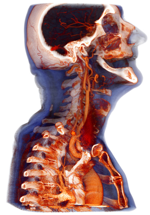 medicalschool: Head-Neck Angiography Volume Rendering of a contrast enhanced CT angiography of the s