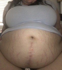 plump-piggy:  My stretch marks in all their unfiltered glory!! And the really big red scar is surgical not a stretchie ❤️❤️