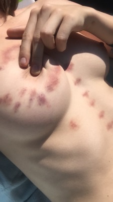 kingdomofnudes:  Once upon a time, I dated a girl who loved to give me hickeys. She would cover my body in her love bites and I enjoyed every fucking minute of it. -the queen