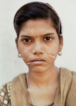 whenwilligetmyrights:  “Every time someone says we don’t need feminism anymore, things like this come to mind. Due to insufficient dowry this young girl’s husband lacerated her face with a razor blade.” (Gwalior - India) - ph. Adrian Fisk 