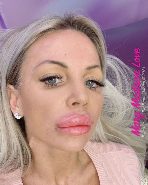 New lip filler today! I am really happy the result is amazing.I love this. ♥️ #lips #filling #pic #b