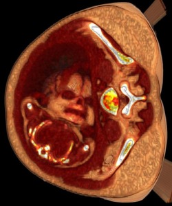 sixpenceee:  A CT scan of a pregnant woman. 