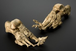 Skeleton showing the effects of leprosy,