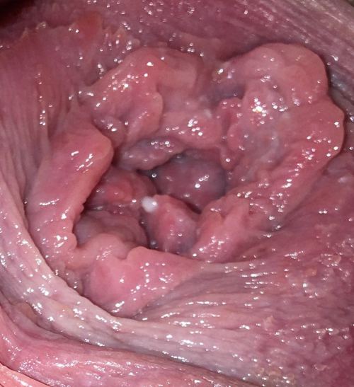daddybearandprincesspants:  This is the aftermath of what happens when you love stretching your pussy. 30 pumps of an inflatable plug in her Princess pussy. Bigger than her fist. She is absolutely ruined after playing and she is gaping like crazy… 