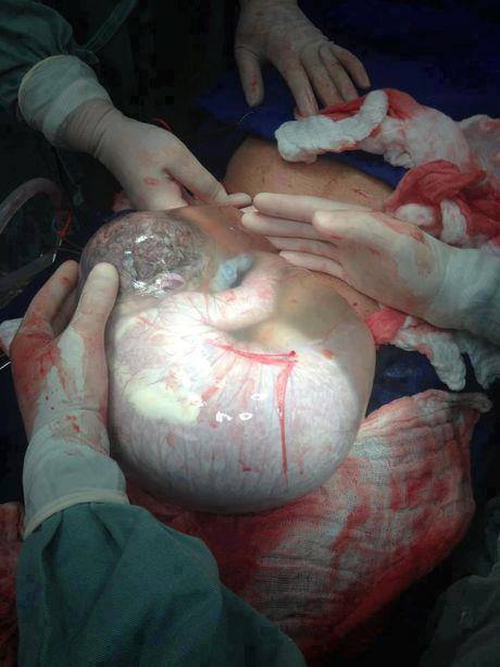 C-section newborn with amniotic sac intact. The baby still breaths &amp; feeds from the placenta