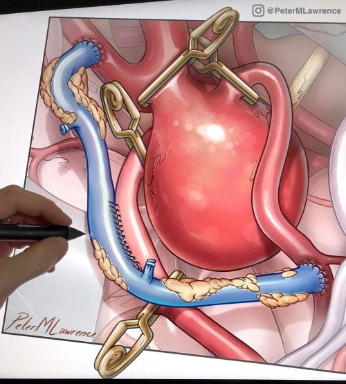 Giant MCA aneurysm #neurosurgery #bypasssurgery #brain #surgery #medicine #photoshoptutorial #brains