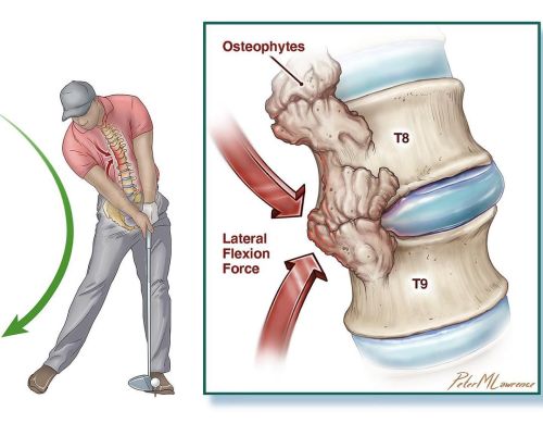 New work published in Current Sports Medicine Reports for the article, Asymmetrical Thoracic Osteoph