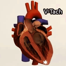 flyonthewallmedstudent:  dieselotherapy:  Ventricular Tachycardia (V-Tach)  Ventricular