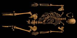 sixpenceee:  Shakespeare described King Richard III as being a &quot;bunchback’d toad&quot; but King Richard III had a twisted spine instead. He had scoliosis or an abnormal curving of the spine. Richard had a curvature around 70-80 degrees.  And was