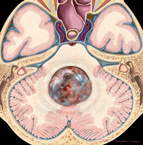 medicalschool:homo-medicus:MedulloblastomaMedulloblastoma is a highly malignant primary brain tumor 