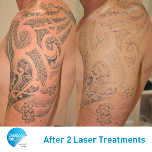 Laser Tattoo Removal  Before  After