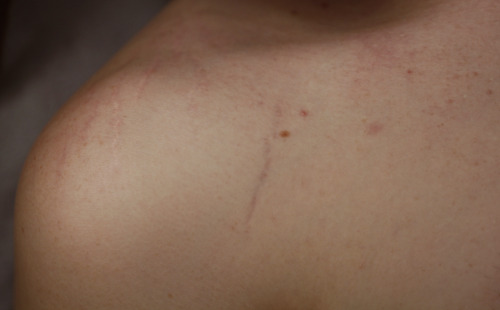 ginocchia:  My boyfriend’s stretch marks, one of the most beautiful things I’ve ever seen.
