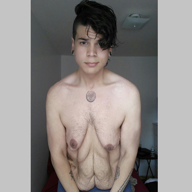 mattjosephdiaz:  Two weeks before I posted the video showing my excess skin, I met