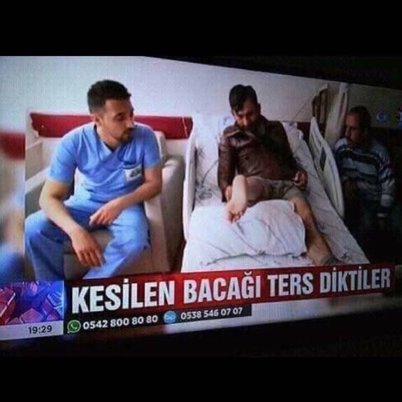 Kesilen bacağı ters diktiler.