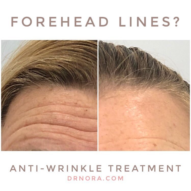 Fantastic way to end the week! 😊👌 This lovely patient had anti-wrinkle treatment to her forehead and she looks great! Anti-wrinkle therapy is a quick and easy way to minimise signs of ageing and is expected to last from 3-5 months.
Book in today for...