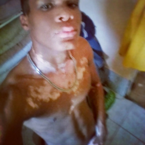 jamaicangayboy:  Jamaican vitiligo straight boy .