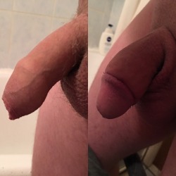 drevil24:  Before and after my circumcised (in first day), please comment what do you think :)  Fuck so much better cut