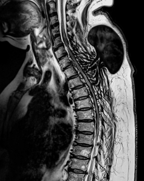 An MRI scan of a person's cervical and thoracic spine, seen from the side. Behind the person's neck, a large dark sac has made its home beneath the skin. From it, a network of black roots emerges, eating through bone and reaching around the spinal cord.