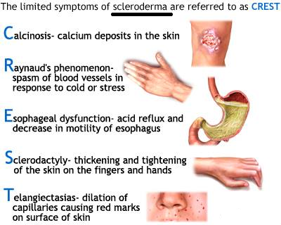 usmlenotes:  Symptoms of Scleroderma mnemonic!