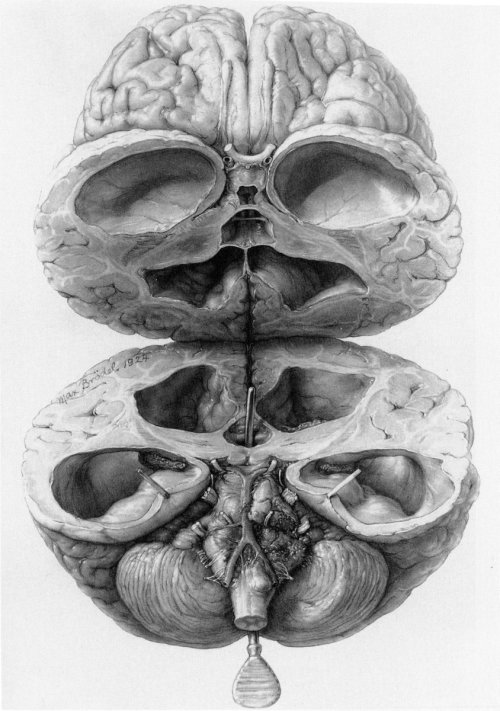 Communicating Hydrocephalus In An InfantDrawn by Max Brödel in 1924. In this drawing, Brödel illustr