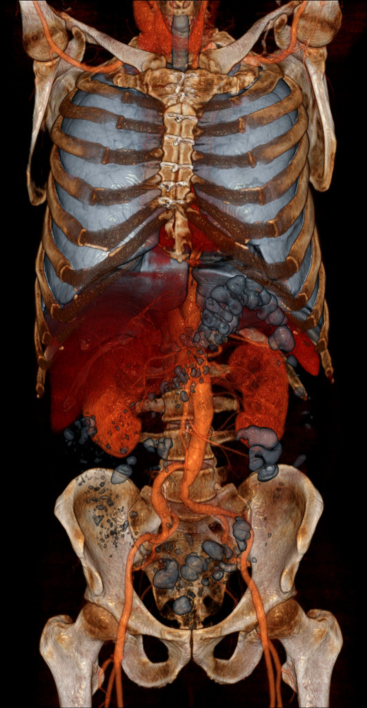 Volume Rendering CT Scans By Voxel123