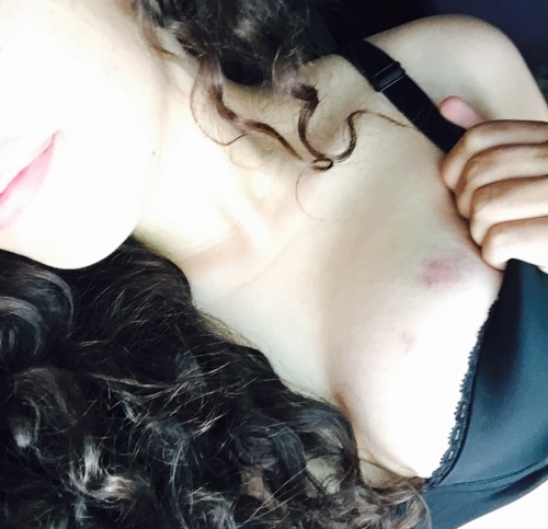 nudebruisedgirls:  More hot bruised girls