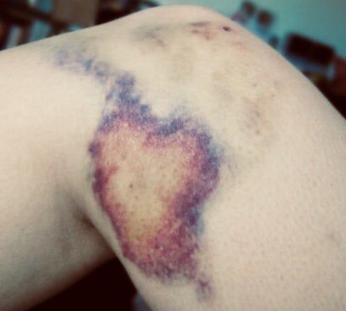 ♥️✨💜 Bruises ♥️✨💜