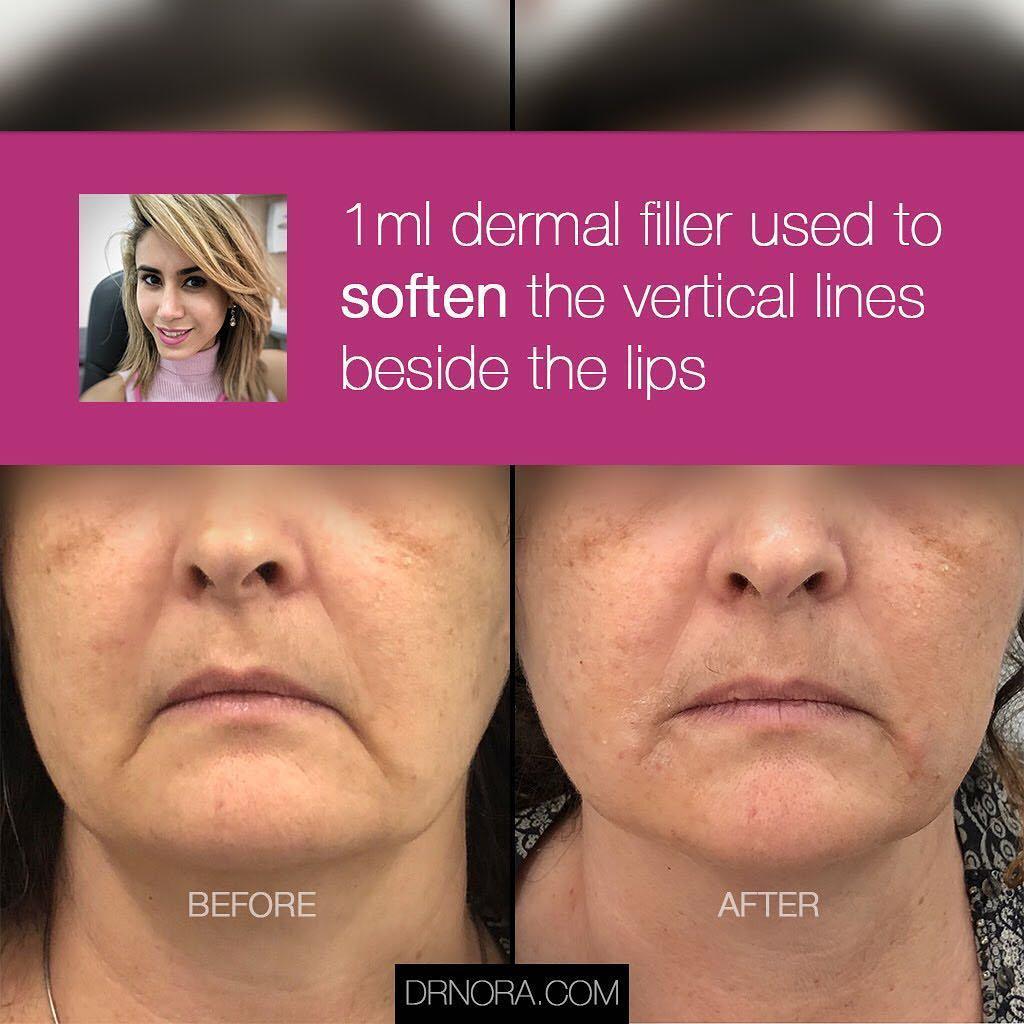 Look sad but don’t feel it? 🙃Turn that smile from upside down with some dermal filler carefully placed along the vertical lines beside the lips to create an upward smile. This beauty’s face looks fresher and happier.
With results from the filler seen...