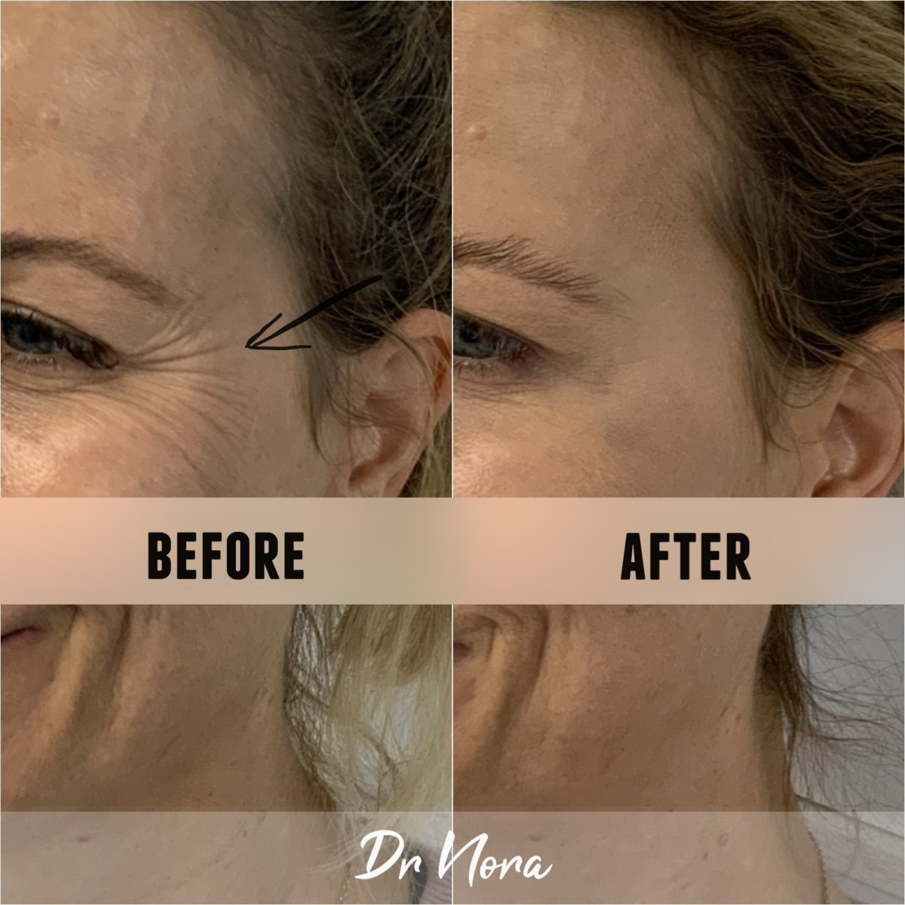 Anti-wrinkle treatment of smile lines ðŸ˜†Anti-wrinkle therapy is a way to reduce the appearance of strong and deep lines around the eyes. Treatment time is 15 minutes, optimal results are seen at 2 weeks and lasts up to 3-5 months.
If you have any...