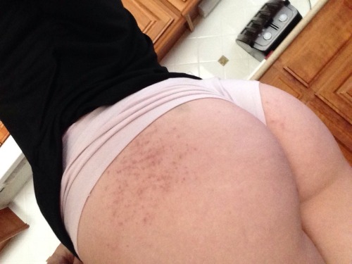 applepetals:bruised butt day 2