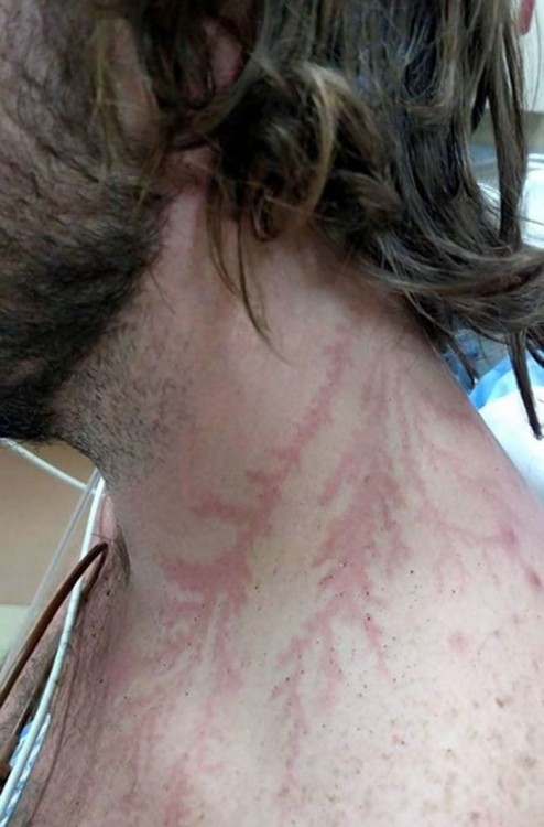 sixpenceee:   Being strunk by lightning can leave a tattoo-like marking or scar known as a Lichtenberg figure.                             Source