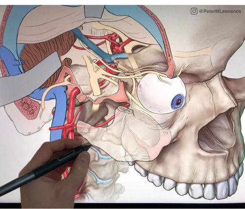 Work in progress. This is going to be a fun one to render#neurological #avm #resection #medicalillus