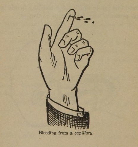 nemfrog: Bleeding from a capillary. Nursing in the home. 1925.