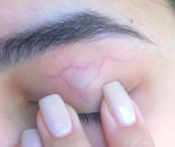 lolita-mami:  xx-27:  I’ve had this heart shaped vein in my eyelid for as long as i can remember.  💗👼🏿sad princess👼🏿💗