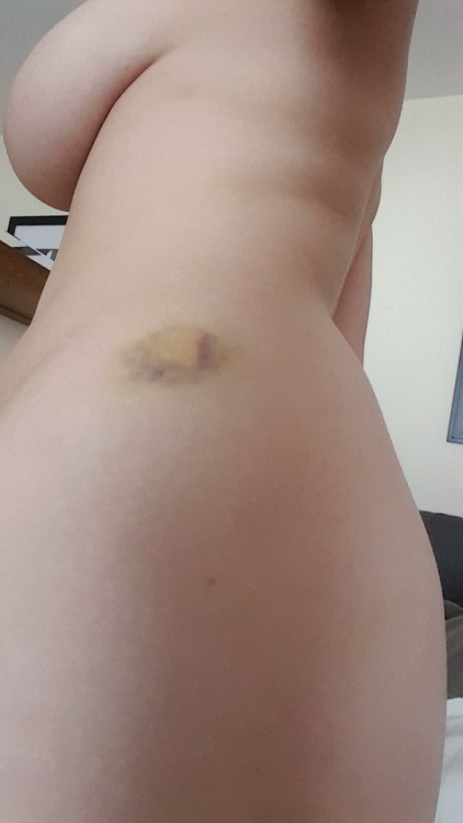 sweetmidnightmoans:  Got some mysterious post-move bruises 👻👽