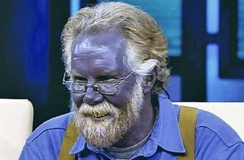 drankinwatahmelin:  sixpenceee:  A condition caused by the ingestion of silver, the