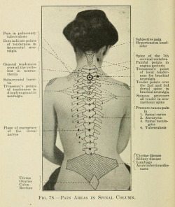 nemfrog:  Fig. 78. Pain areas in spinal column. Pain,