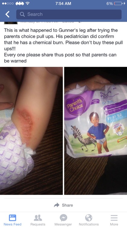 timemakesyou:   rosexxxblack:  wanderingobsidian:  These are giving babies chemical burns!!!  Please reblog and spread the news to not buy Parent Choice diapers due to them having harsh chemicals that harm cause terrible burns to little ones like this.