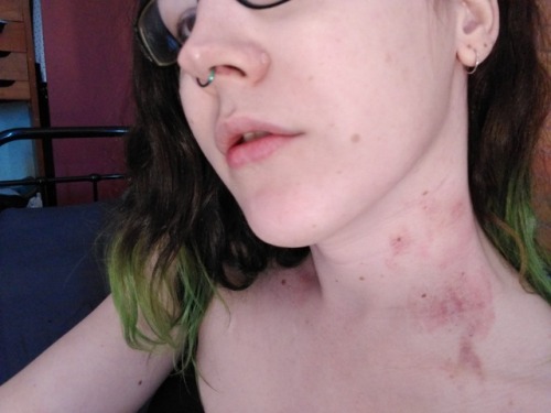 asciiheart:  someone bit me!  someone bit porn pictures