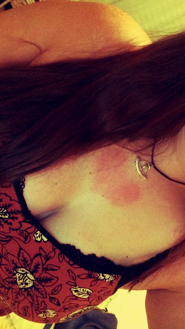 Yesterday my anxiety rash was in the shape of a heart and idk it was slightly comforting