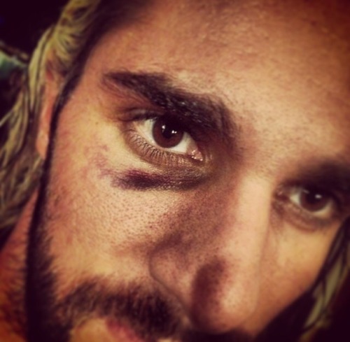 ambrose-addict:Seth Rollins-black eye.