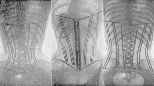 Le Corset by Ludovic O’Followell.
In 1908, a French doctor, Ludovic O’Followell, used x-ray radiography, a medical technology that at the time was still in its infancy, to demonstrate the potential health detriments of the corset.
A picture speaks a...