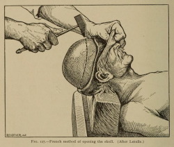 nemfrog:Fig. 127. French method of opening the skull. Post-mortem pathology. 1905.