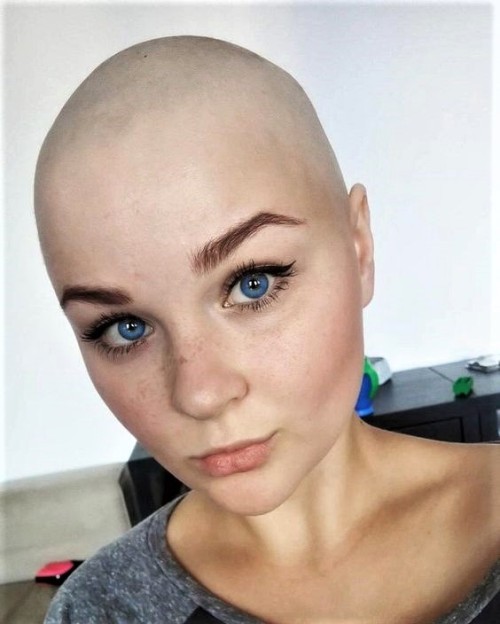 plattithings:beautiful freckled and bald Feine Sommersprossen