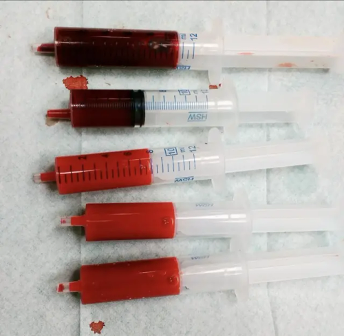 Difference In Hue Between Arterial (brighter) And Venous (darker) Blood.